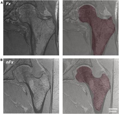 Radiomic analysis of the proximal femur in osteoporosis women using 3T MRI